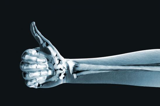 X-ray pikeun mendiagnosis nyeri dina sendi ramo