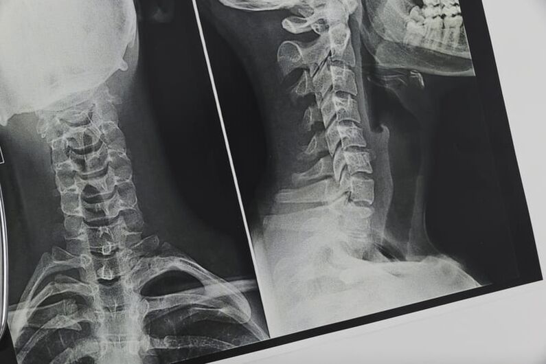 X-ray tina tulang tonggong cervical kapangaruhan ku osteochondrosis