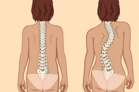 dedeg sikep jeung scoliosis kalawan osteochondrosis thoracic