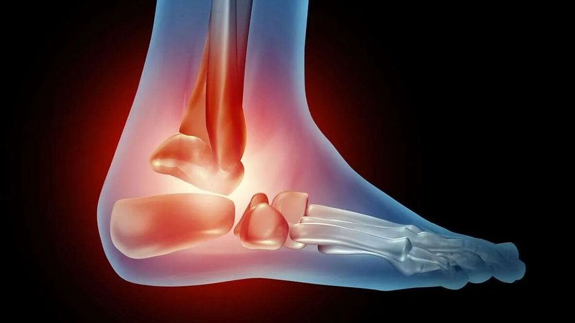 diagram arthrosis ankle