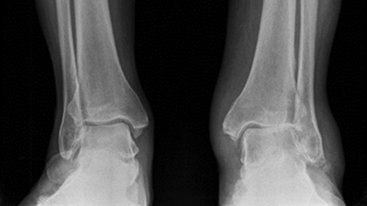 x-ray ankle