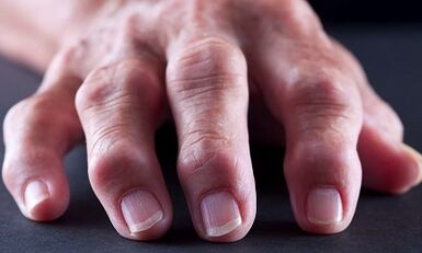 Naon bédana antara arthritis ti arthrosis