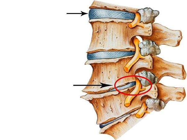 Gangguan dina cakram intervertebral