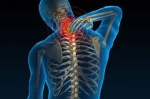 osteochristrosis cervical ngabalukarkeun sorek dina beuheung