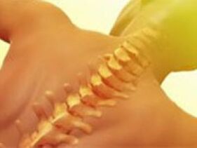 Osteochondrosis - Panyakit Spine