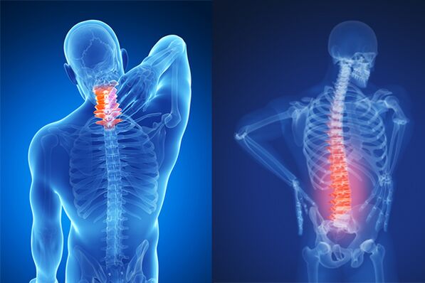 Osteochondrosis tina tulang tonggong cervical sareng lumbar