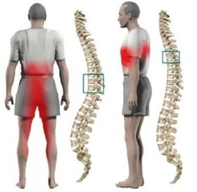 Protrusions dina tulang tonggong