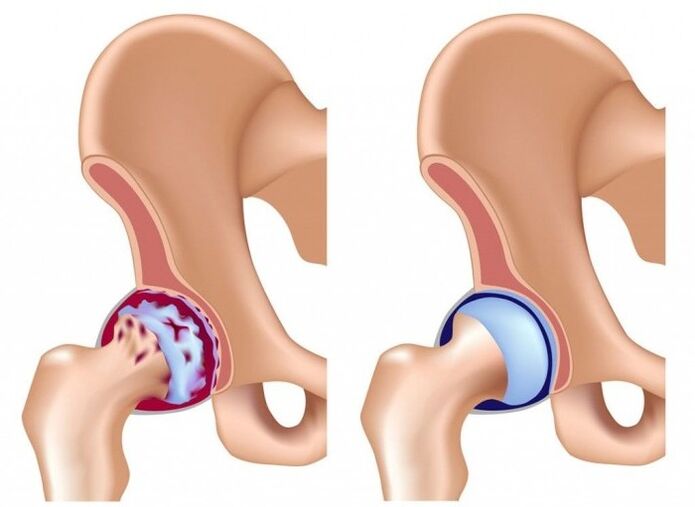 Ruksakna gabungan hip alatan arthrosis