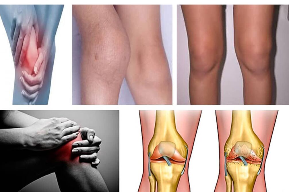 arthrosis naon éta