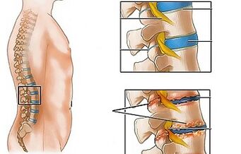 Anu nyababkeun osteochondrice tina lumbar